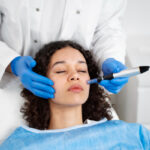 Microneedling for acne scars treatment being performed on a woman’s face by a licensed aesthetic professional