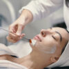 Woman receiving a professional chemical peel treatment demonstrating chemical peel benefits for smoother and brighter skin